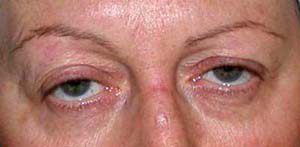 chirurgie-esthetique-interventions-paupieres-006