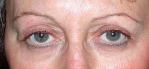 chirurgie-esthetique-interventions-paupieres-007