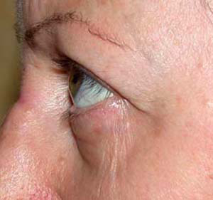chirurgie-esthetique-interventions-paupieres-008