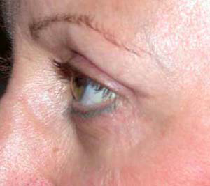 chirurgie-esthetique-interventions-paupieres-009