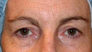 chirurgie-esthetique-interventions-paupieres-010