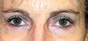 chirurgie-esthetique-interventions-paupieres-011