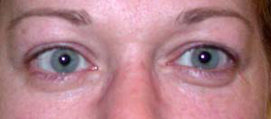 chirurgie-esthetique-interventions-paupieres-012