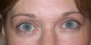 chirurgie-esthetique-interventions-paupieres-013