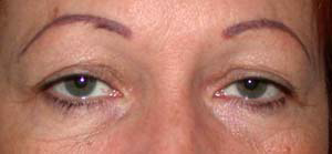 chirurgie-esthetique-interventions-paupieres-014