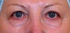 chirurgie-esthetique-interventions-paupieres-016