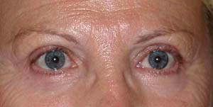 chirurgie-esthetique-interventions-paupieres-017