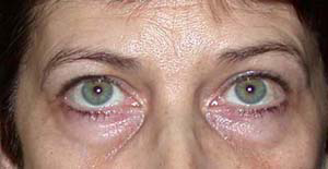 chirurgie-esthetique-interventions-paupieres-018