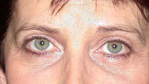 chirurgie-esthetique-interventions-paupieres-019