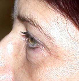 chirurgie-esthetique-interventions-paupieres-020
