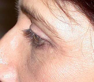 chirurgie-esthetique-interventions-paupieres-021