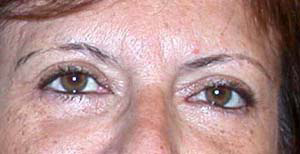 chirurgie-esthetique-interventions-paupieres-023