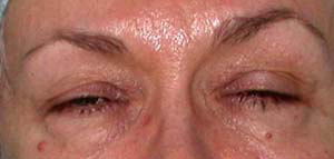 chirurgie-esthetique-interventions-paupieres-024