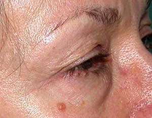 chirurgie-esthetique-interventions-paupieres-026