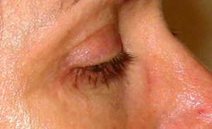 chirurgie-esthetique-interventions-paupieres-027