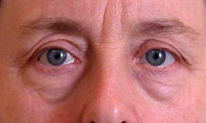 chirurgie-esthetique-interventions-paupieres-028