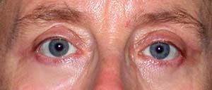 chirurgie-esthetique-interventions-paupieres-029