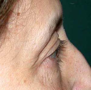 chirurgie-esthetique-interventions-paupieres-032