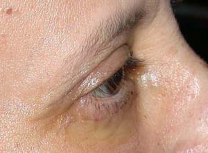chirurgie-esthetique-interventions-paupieres-033