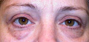 chirurgie-esthetique-interventions-paupieres-034