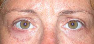 chirurgie-esthetique-interventions-paupieres-035