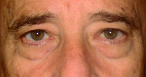 chirurgie-esthetique-interventions-paupieres-036