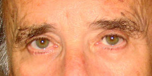 chirurgie-esthetique-interventions-paupieres-037