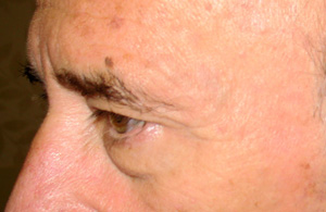 chirurgie-esthetique-interventions-paupieres-038