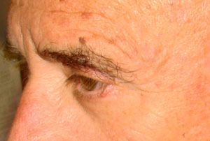 chirurgie-esthetique-interventions-paupieres-039