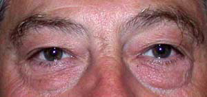 chirurgie-esthetique-interventions-paupieres-040