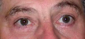 chirurgie-esthetique-interventions-paupieres-041