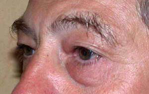 chirurgie-esthetique-interventions-paupieres-042