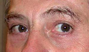 chirurgie-esthetique-interventions-paupieres-043