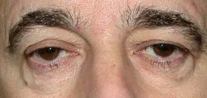 chirurgie-esthetique-interventions-paupieres-044