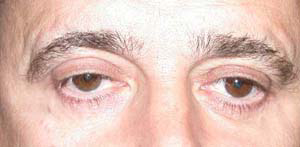 chirurgie-esthetique-interventions-paupieres-045