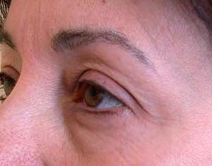 chirurgie-esthetique-interventions-paupieres-046