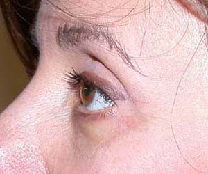chirurgie-esthetique-interventions-paupieres-047