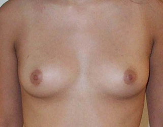 chirurgie-esthetique-interventions-seins-augmentations-mammaires-005