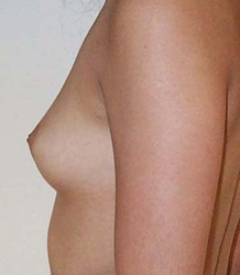 chirurgie-esthetique-interventions-seins-augmentations-mammaires-007