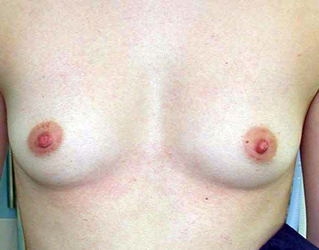 chirurgie-esthetique-interventions-seins-augmentations-mammaires-013