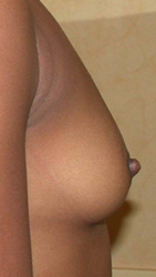 chirurgie-esthetique-interventions-seins-augmentations-mammaires-015