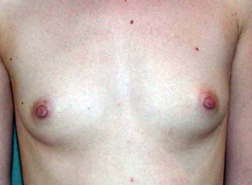 chirurgie-esthetique-interventions-seins-augmentations-mammaires-017