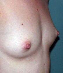 chirurgie-esthetique-interventions-seins-augmentations-mammaires-019