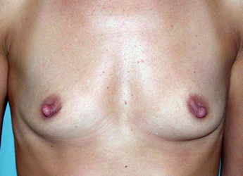 chirurgie-esthetique-interventions-seins-augmentations-mammaires-021