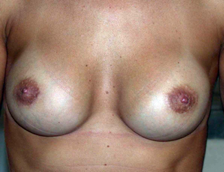 chirurgie-esthetique-interventions-seins-augmentations-mammaires-022