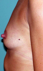 chirurgie-esthetique-interventions-seins-augmentations-mammaires-023