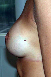 chirurgie-esthetique-interventions-seins-augmentations-mammaires-024