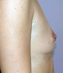 chirurgie-esthetique-interventions-seins-augmentations-mammaires-025