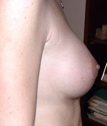 chirurgie-esthetique-interventions-seins-augmentations-mammaires-026