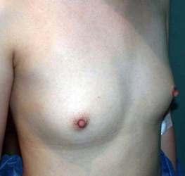 chirurgie-esthetique-interventions-seins-augmentations-mammaires-029